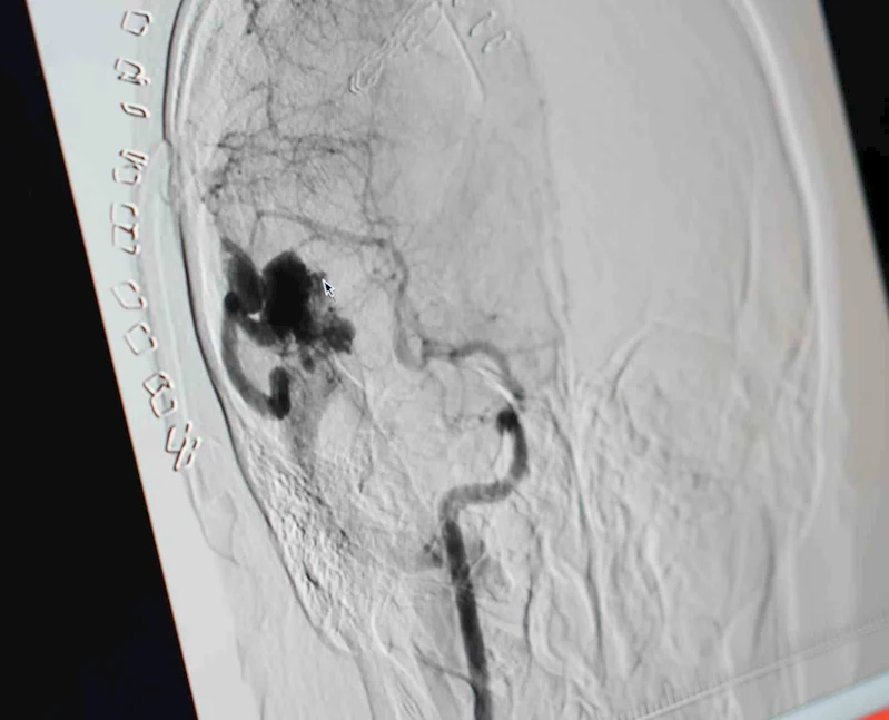 Genç kız hastaneye komada geldi, yürüyerek çıkti
