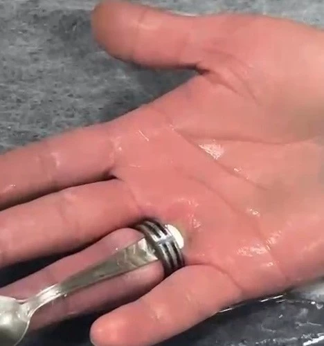 Parmağa sıkışan yüzük kesilerek çıkarıldı
