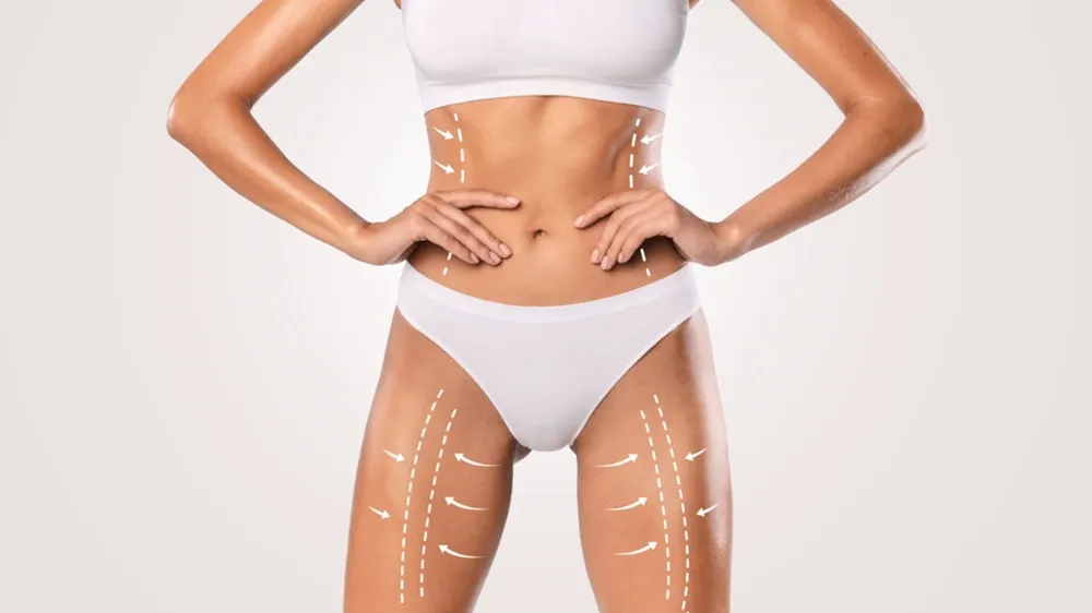 Liposuction Ameliyatı ile İnce Vücuda Kavuşun 